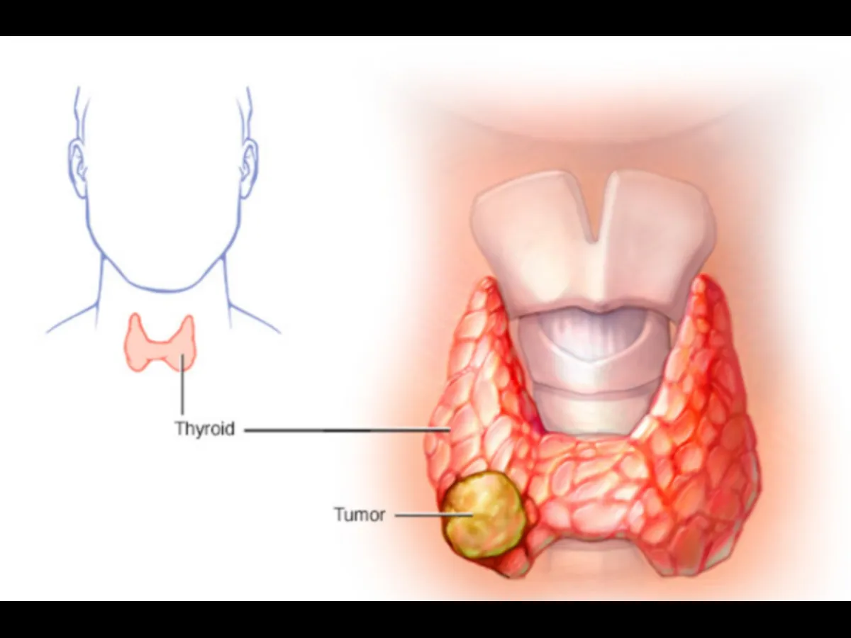 Всё о аномалиях щитовидной железы: от причин до методов лечения