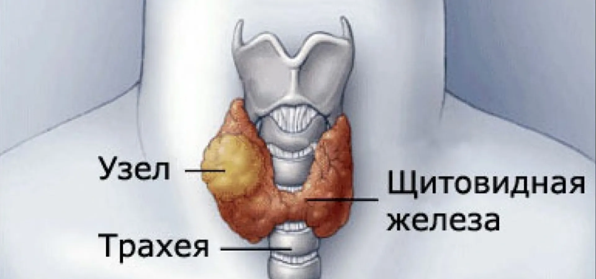 Коллоидный зоб: Понимание, Диагностика и Лечение